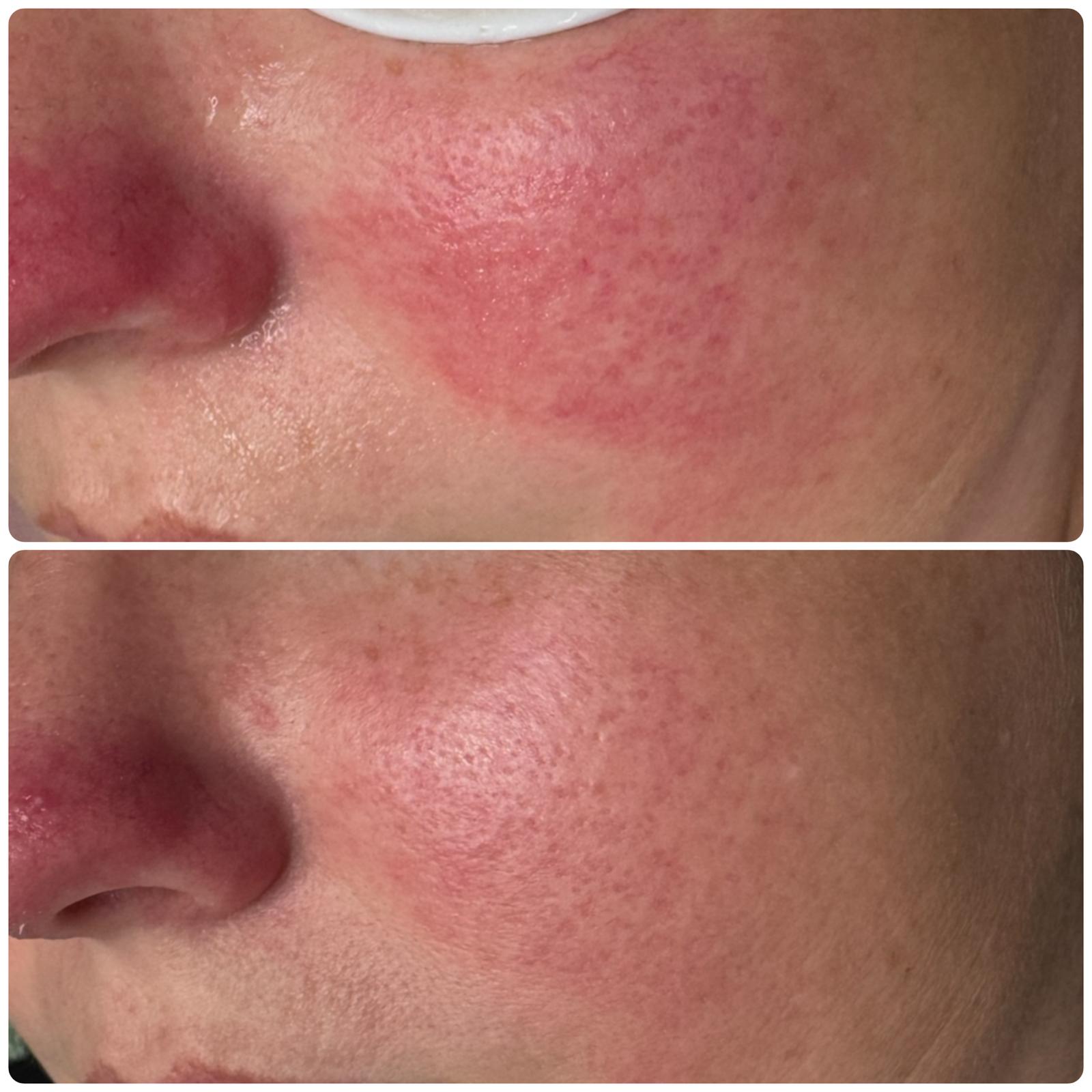 Before and after — Redness & flushing