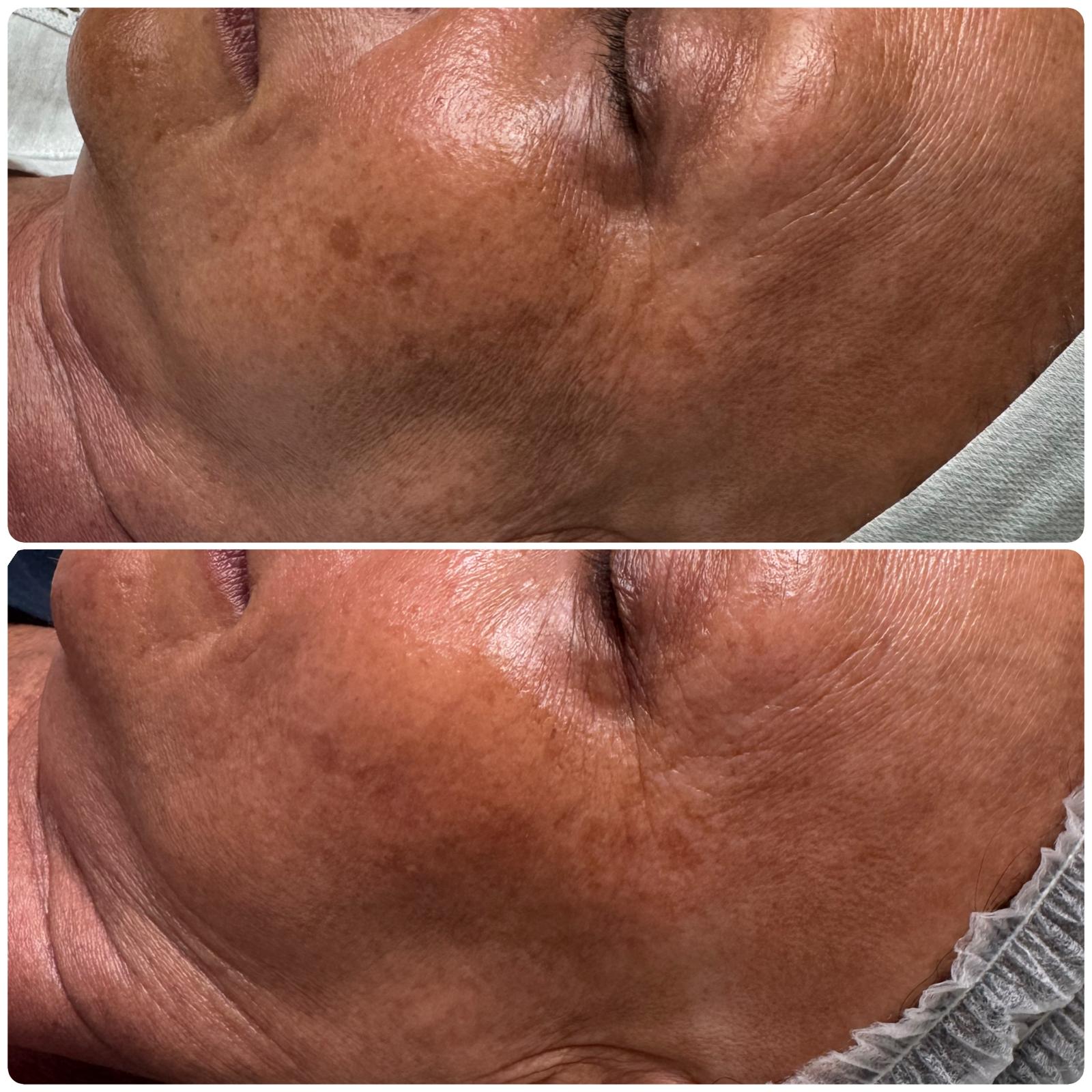 Before and after — Melasma