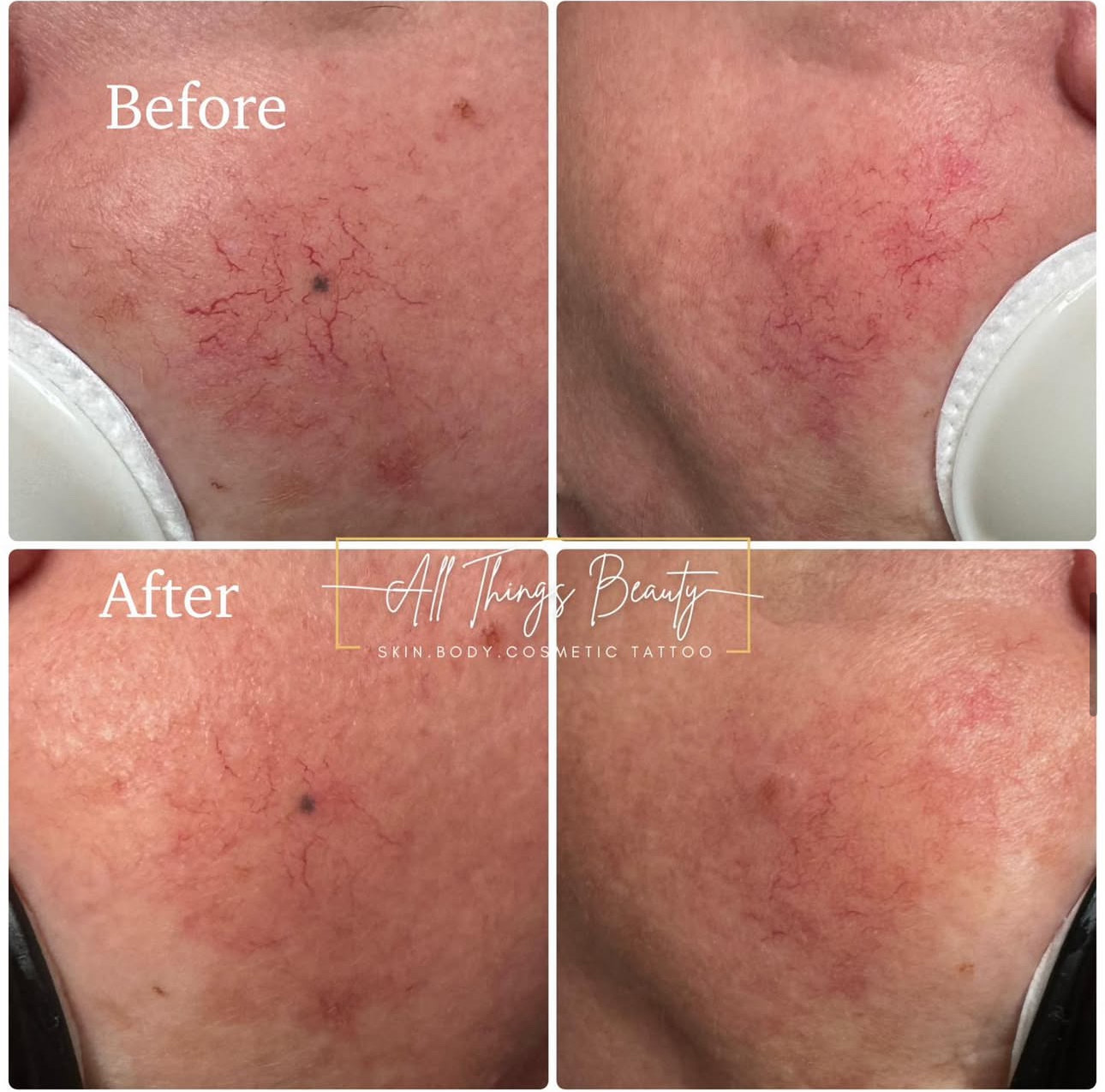 Before and after — Rosacea